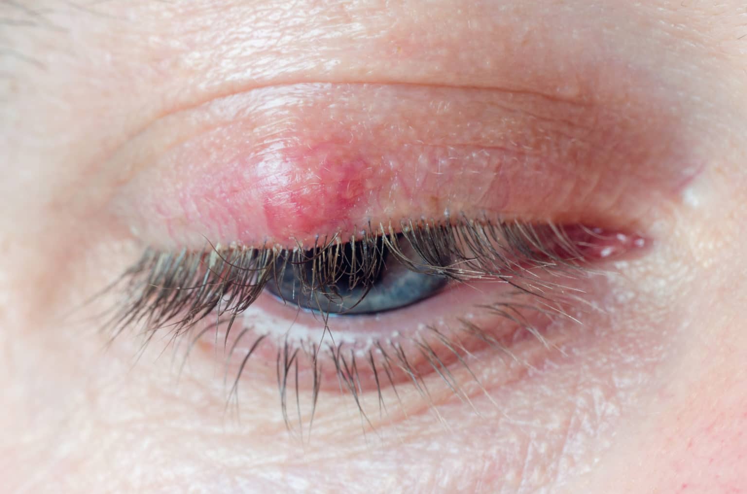 Chalazion Removal Boston MA Eye Stye Specialist Near Me Cost